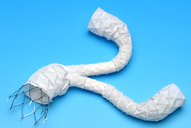 The INCRAFT Stent-Graft System from Cordis Johnson & Johnson